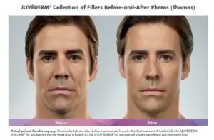 Juvedermยฎ Before and After Pictures Brentwood, TN