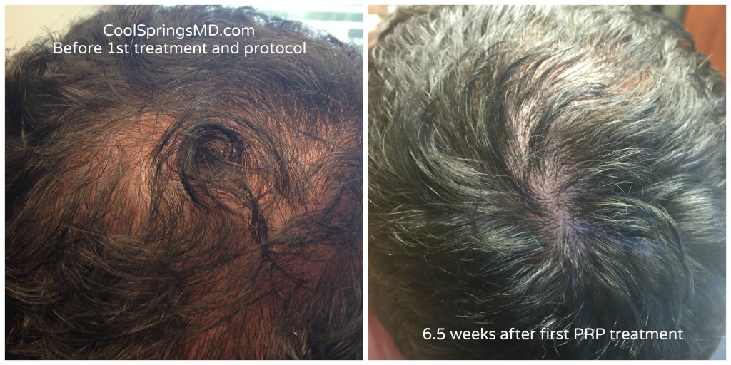 Hair Restoration Before and After Pictures Brentwood, TN