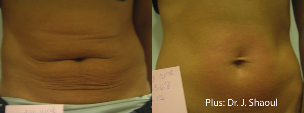 Wrinkle Treatments Before and After Pictures Brentwood, TN