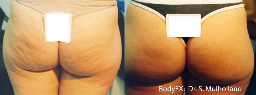 Body FX Before and After Pictures Brentwood, TN