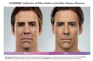 Juvederm® Before and After Pictures Brentwood, TN