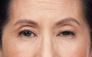 Botox® Before and After Pictures Brentwood, TN