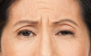 Botox® Before and After Pictures Brentwood, TN