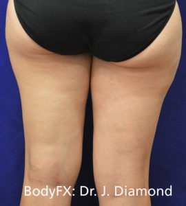 BodyFX Before and After Pictures Brentwood, TN