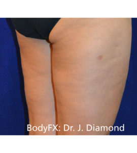 BodyFX Before and After Pictures Brentwood, TN