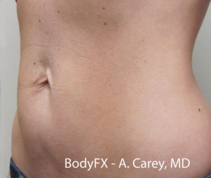 BodyFX Before and After Pictures Brentwood, TN