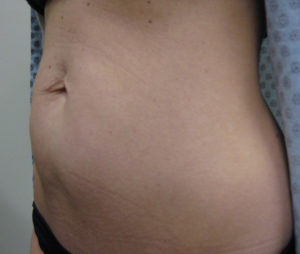 BodyFX Before and After Pictures Brentwood, TN