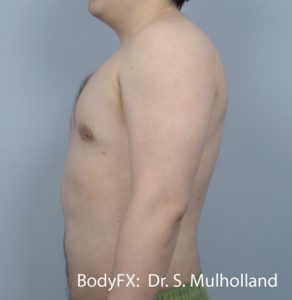 BodyFX Before and After Pictures Brentwood, TN