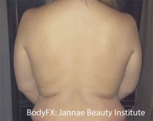 BodyFX Before and After Pictures Brentwood, TN