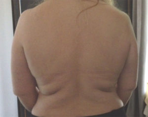 BodyFX Before and After Pictures Brentwood, TN