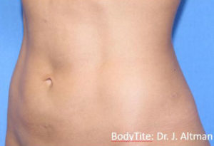 BodyTite™ Before and After Pictures Brentwood, TN