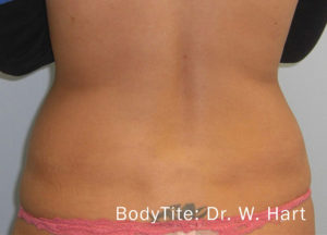 BodyTite™ Before and After Pictures Brentwood, TN