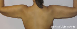 BodyTite™ Before and After Pictures Brentwood, TN