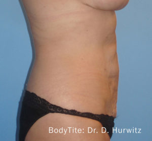 BodyTite™ Before and After Pictures Brentwood, TN