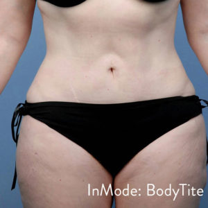 BodyTite™ Before and After Pictures Brentwood, TN