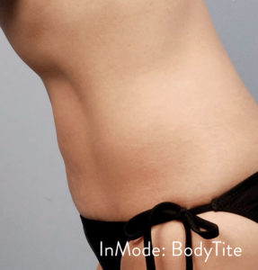 BodyTite™ Before and After Pictures Brentwood, TN