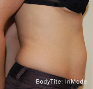 BodyTite™ Before and After Pictures Brentwood, TN