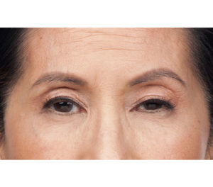 Botox® Before and After Pictures Brentwood, TN