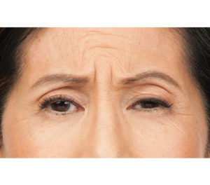 Botox® Before and After Pictures Brentwood, TN