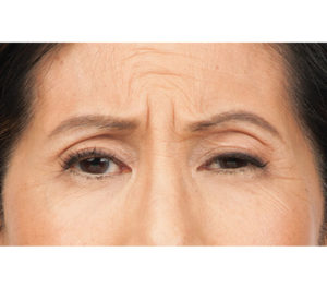 Botox® Before and After Pictures Brentwood, TN