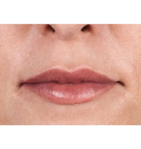 Juvederm® Before and After Pictures Brentwood, TN