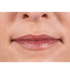 Juvederm® Before and After Pictures Brentwood, TN