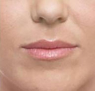 Juvederm® Before and After Pictures Brentwood, TN