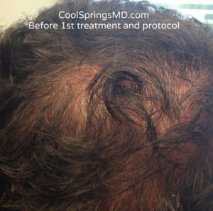 Hair Restoration Before and After Pictures Brentwood, TN